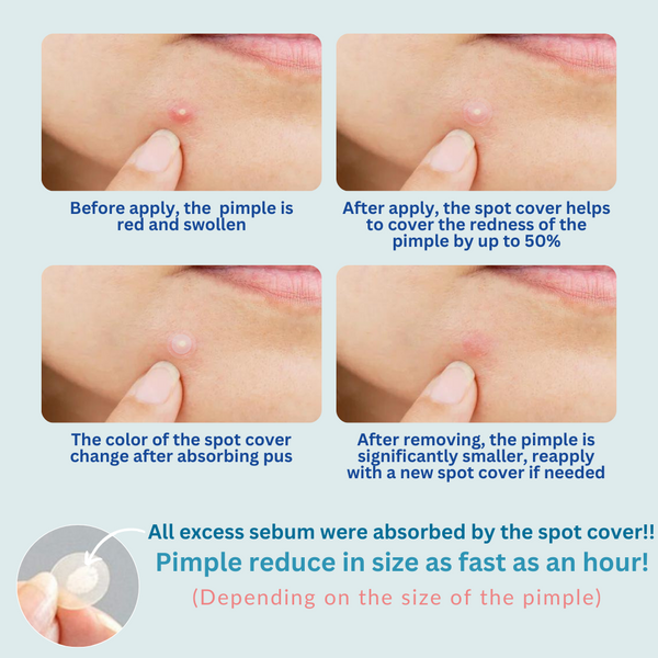 Oldam Pimple Spot Cover